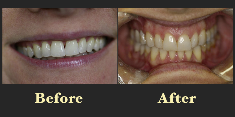 Side-by-side before and after dental photos showing the correction of slightly misaligned teeth for a more symmetrical smile.
