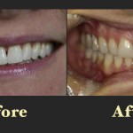 Side-by-side before and after dental photos showing the correction of slightly misaligned teeth for a more symmetrical smile.