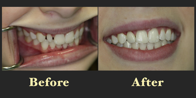Before and after comparison of a patient's smile transition from crowded front teeth to a straightened alignment