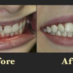 Before and after comparison of a patient's smile transition from crowded front teeth to a straightened alignment