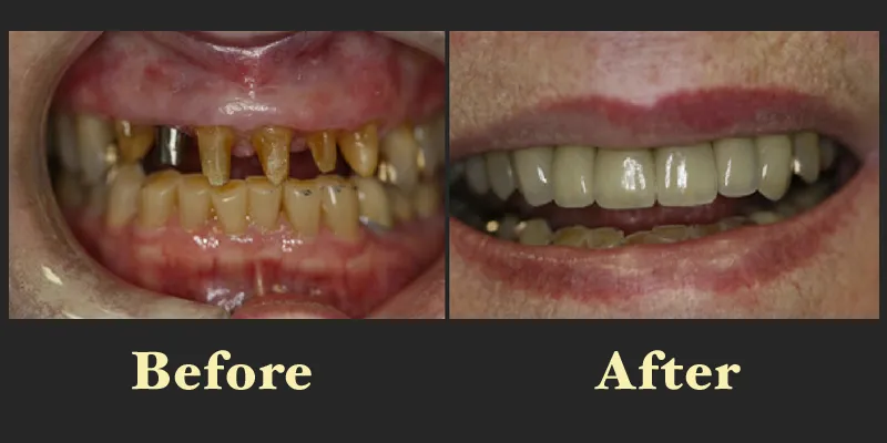 A dramatic restorative transformation showing the transition from severely worn and damaged teeth to a full set of healthy-looking dental crowns