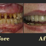 A dramatic restorative transformation showing the transition from severely worn and damaged teeth to a full set of healthy-looking dental crowns