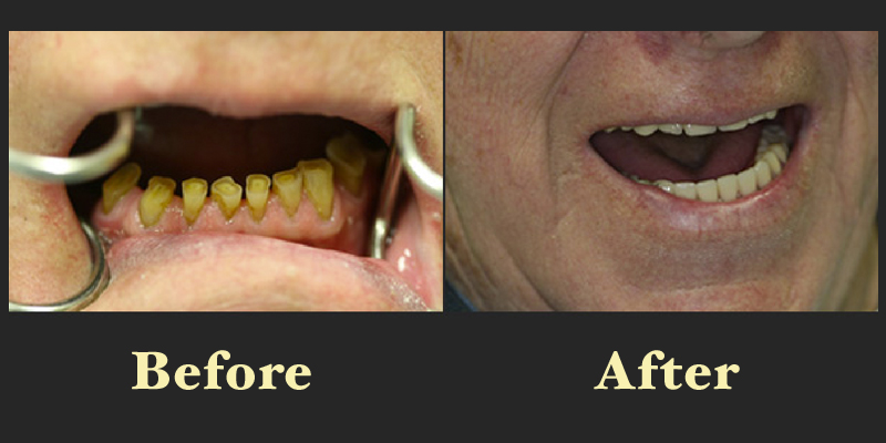 Before and after dental reconstruction photos showing the replacement of missing teeth with a functional and aesthetic bridge or denture