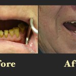 Before and after dental reconstruction photos showing the replacement of missing teeth with a functional and aesthetic bridge or denture