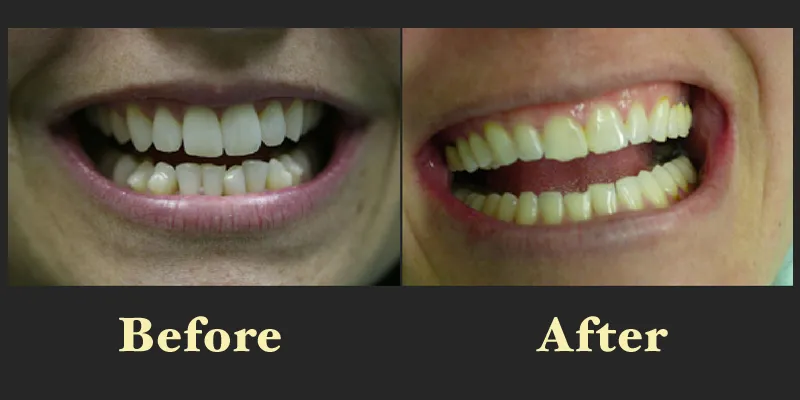 Comparison of a patient's smile before and after orthodontic or restorative treatment to improve tooth spacing and color