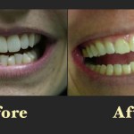 Comparison of a patient's smile before and after orthodontic or restorative treatment to improve tooth spacing and color