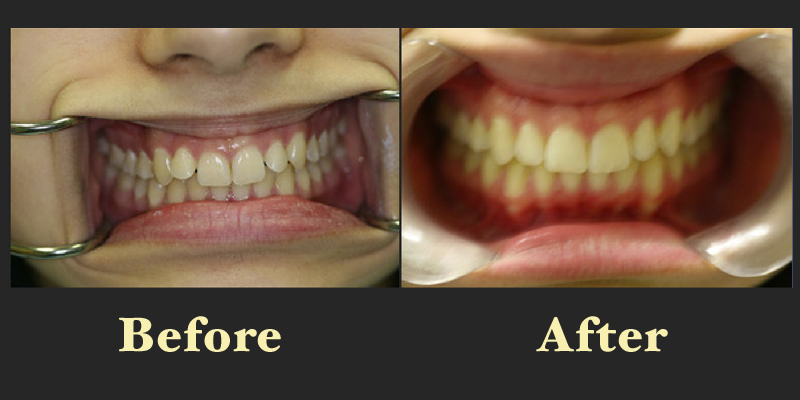 Before and after dental images focusing on the correction of moderate tooth crowding in the upper arch