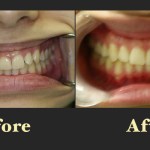 Before and after dental images focusing on the correction of moderate tooth crowding in the upper arch