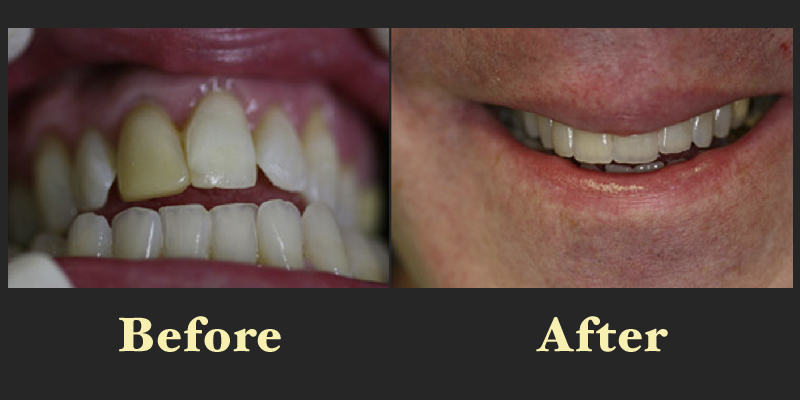 A dental restoration transformation showing the replacement of a discolored front tooth with a natural-looking crown or veneer