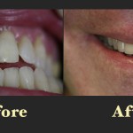 A dental restoration transformation showing the replacement of a discolored front tooth with a natural-looking crown or veneer