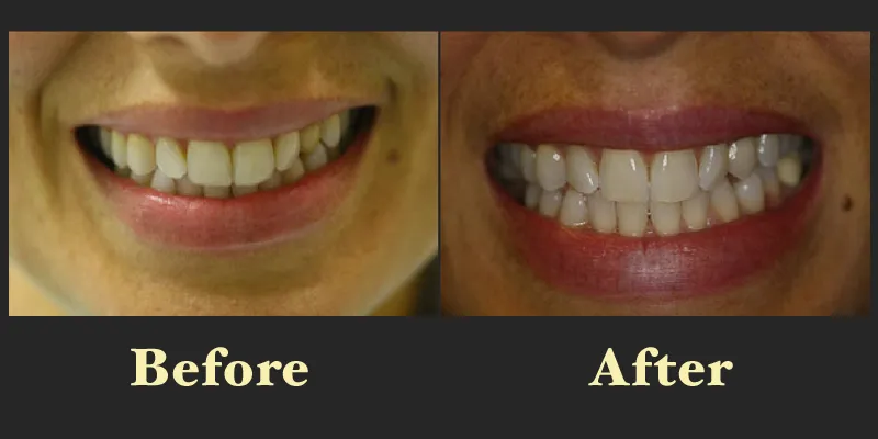 Before and after photos of a professional teeth whitening treatment, demonstrating a brighter and more vibrant smile