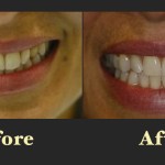 Before and after photos of a professional teeth whitening treatment, demonstrating a brighter and more vibrant smile
