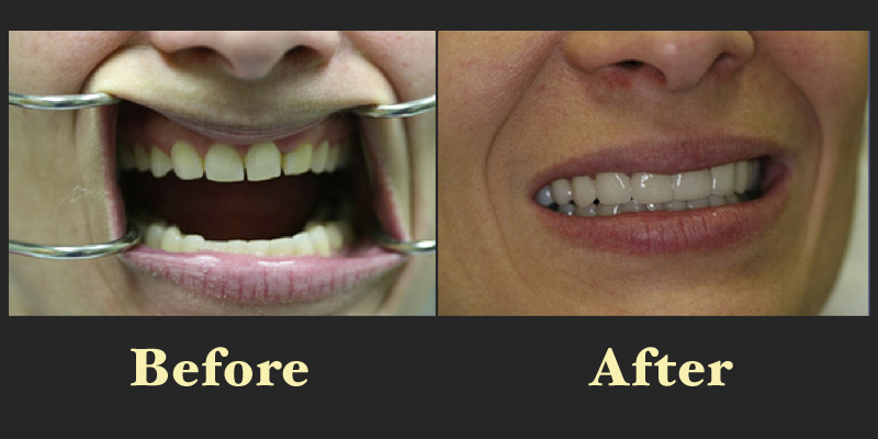 Clinical before and after shots showing the successful alignment of an open bite and crowded teeth