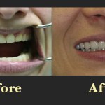 Clinical before and after shots showing the successful alignment of an open bite and crowded teeth