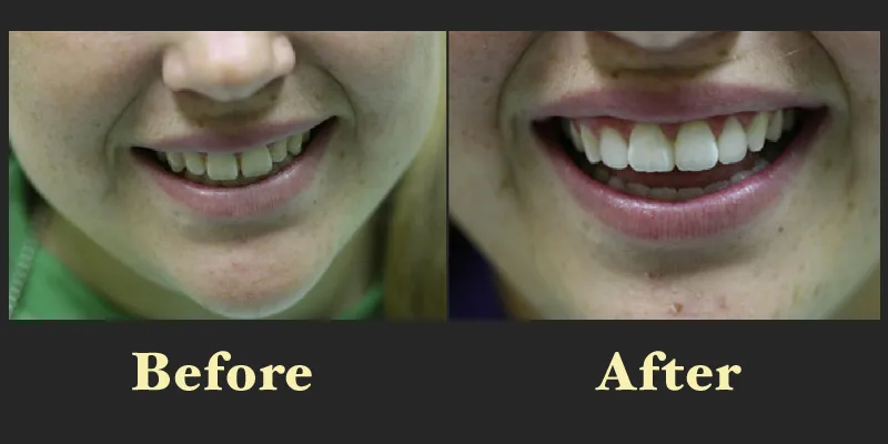 A subtle yet effective smile enhancement showing the closing of small gaps between the front teeth in the after photo