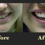 A subtle yet effective smile enhancement showing the closing of small gaps between the front teeth in the after photo
