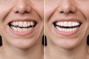 Cropped shot of a young women before and after veneers