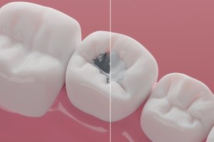 Graphic depiction of a tooth with a Composite Tooth Colored Filling on the right vs Amalgam on the left